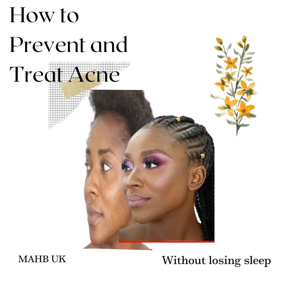 How to Prevent and Treat Acne without Losing Sleep MAHB